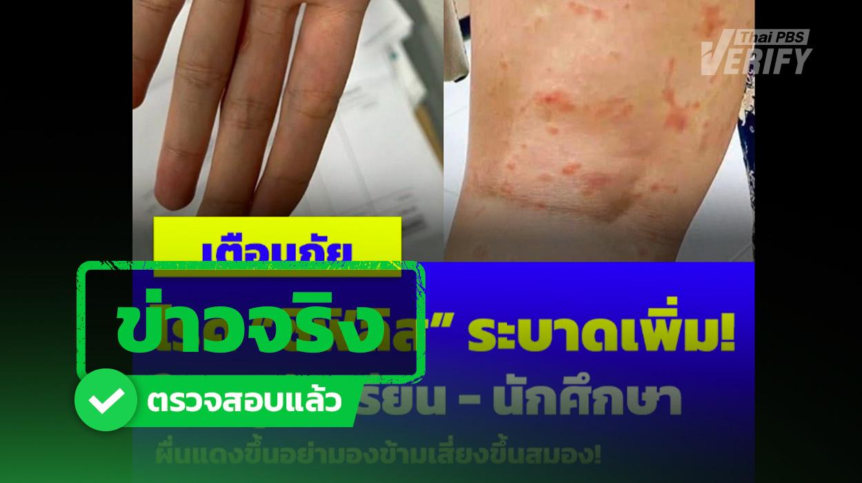 เชื้อซิฟิลิสสามารถติดเชื้อขึ้นสมองได้จริง แพทย์ชี้หากมีความเสี่ยงให้รีบรักษา
